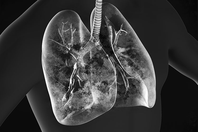 肺がんイメージ画像